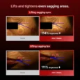wrinkle fit needle 5
