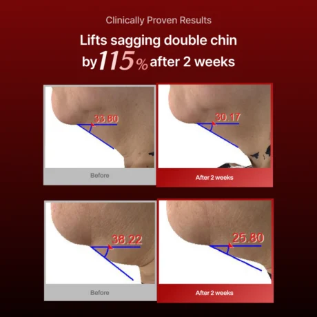 wrinkle fit needle 6
