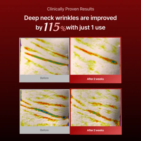wrinkle fit needle 7