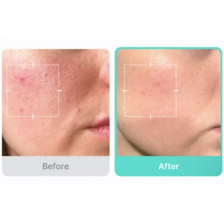 azelaic acid 16 bb soothing serum 6